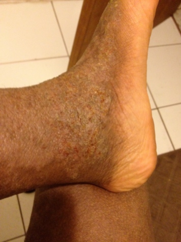Taken today: Aug 21. Left foot: super thick crust from oozing, and painful to walk on.
